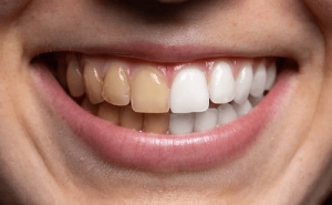 خمیر دندان سفید کننده 5 دقیقه ای میسویک | 50 میل